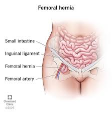 Image result for Inguinal hernia man
