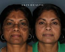⭐️Holiday Ready Skin ⭐️ . A beautiful result courtesy ZO SkinHealth  topicals and our experts at The Skin Health Institute. . Take advantage of  1️⃣7️⃣% OFF all #products and #services at our