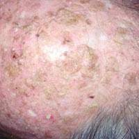 This is a reminder, with the summer coming on (in the northern hemisphere) that if you go bald, you should wear a hat. Can Scabs On Scalp Be Cancer Scary Symptoms