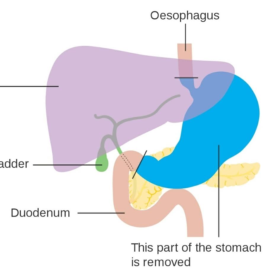 Stomach cancer surgery product image