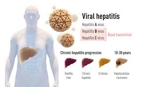 When hepatitis b and c become chronic, they may cause no symptoms for years. 3 Penemu Virus Hepatitis C Raih Nobel Kedokteran 2020 Kumparan Com