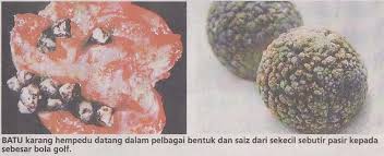 Hempedu pundi hempedu cecair ini dihasilkan di dalam hati dan digunakan untuk pencernaan lemak ke usus kecil. Simptom Simptom Penyakit Batu Karang Hempedu Sembang Ilmiah Bukan Sekadar Sembang