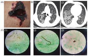 Image result for Microscopic Polyangiitis