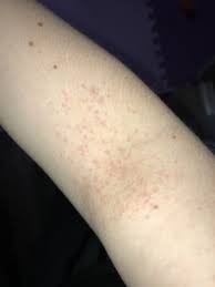 Estrogen Hives
