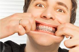 May 28, 2021 · if they ask for your assistance, wrap a piece of clean gauze around the tooth and gently wiggle it back and forward. How To Handle An Orthodontic Emergency Orthodontic Associates