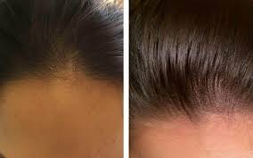 Why does dht encourage hair loss in the scalp… but hair growth in the chest and face? Scalp Micropigmentation Treatment For Women Sydney Novoscalp