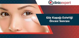 Goz Kapagi Estetigi Oncesi Sonrasi