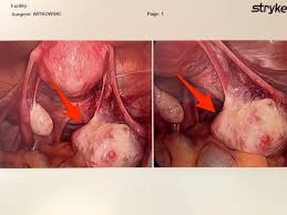My daughter was 16 when she had most of one of her ovaries removed due to a large (benign) cyst. A Woman Had An Cyst On Her Ovary That Contained Hair And Bones