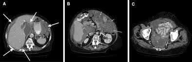 The severity of mesothelioma cancer symptoms may increase as more fluid collects within the peritoneal cavity. Prognostic Role Of Radiological Peritoneal Cancer Index In Malignant Peritoneal Mesothelioma National Cohort Study Scientific Reports