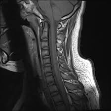 G37.3 acute transverse myelitis in demyelinating disease of central nervous system g37.4 subacute necrotizing myelitis of central nervous system g37.5 concentric sclerosis balo of central nervous system g37.8 other specified demyelinating diseases of central nervous system g37.9 demyelinating disease of central nervous system, unspecified Cervical Transverse Myelitis Radiology Case Radiopaedia Org