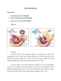 Pap smear merupakan pemeriksaan sederhana yang dikembangkan oleh dr. Sop Pemeriksaan Pap Smear