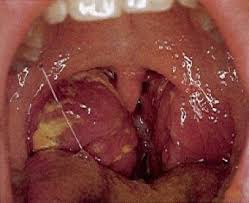 Image result for Tonsillitis