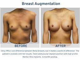 Arm lift body contouring body lift botulinum toxin breast augmentation breast implant removal & exchange breast lift breast reconstruction breast reduction brow lift buttock lift with augmentation chin augmentation cleft lip and palate craniosynostosis surgery dermal fillers ear surgery eyelid surgery facelift gynecomastia surgery hair. Best Breast Augmentation 3800 5725 Alamo Plastic Surgery