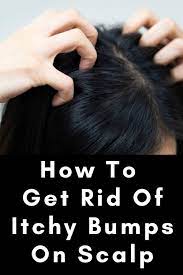 What Causes Itchy Bumps On Scalp And How You Can Get Rid Of Them Itchy Bumps Scalps Dandruff