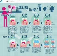 虫歯の進行度と治療 infographics 虫歯 イラスト 虫歯 歯学