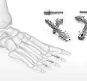 OsteoMed ExtremiFuse Hammertoe Fixation System | Acumed