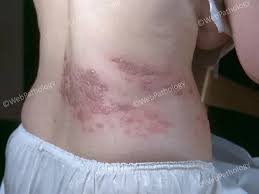 Image result for herpes zoster