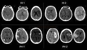 Image result for Hemorrhage Classification