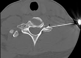 Prof Dr Christian Woiciechowsky Neurochirurgie Berlin Periradikulare Therapie Prt