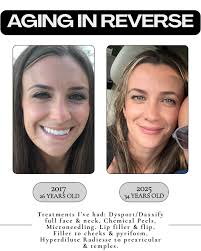 Aesthetic treatments are meant for you to be the best version of yourself.  The goal is for it to always look like you, just refreshed. 8 years between  these pictures. 11 lines