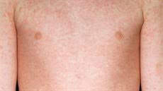 Image result for vyrážka u dětí