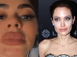 Nadie me quita lo bailao (2018) — el negro mina. El Drama Medico De La Cantante Colombiana Que Se Obsesiono Con Tener Los Labios De Angelina Jolie Infobae
