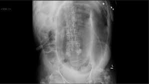 Image result for Sigmoid Volvulus