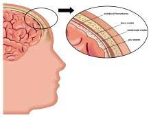 Image result for Brain Contusion