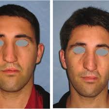 A, A 22-year-old man with type 3A open, grossly contaminated pilon...