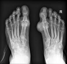 Image result for gout