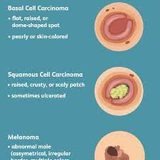 Lung cancer has two broad types: Skin Cancer Signs Symptoms And Complications