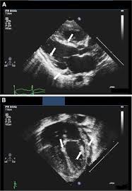 At present, no diagnostic gold standard is. Echocardiographic Detection Of Early Myocardial Calcification In Acute Neonatal Myocarditis Due To Coxsackie Virus Type B Springerlink