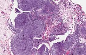 A report of five cases of a facet of a benign neoplasm that may cause diagnostic difficulty. Pathology Outlines Adenomatoid Odontogenic Tumor