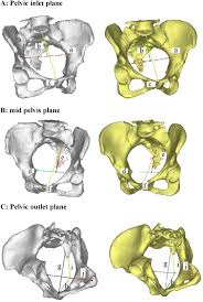 Image result for Pelvimetry