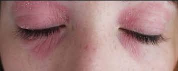 Eyelid Dermatitis Picture Red Dry Itchy Eyelids Eczema On Eyelids Dry Skin Around Eyes Dry Skin Under Eyes
