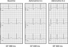 Epinephrine Infusion In The Evaluation Of Unexplained