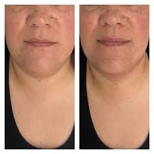 Elles Body Contouring Aesthetics