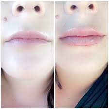 Bellissima medical aesthetics specialize in medical treatments & procedures that achieve amazing results using product injections and dermal fillers, . Bellissima Medical Aesthetics 13 Photos 46 Reviews Medical Spas 6001 Truxtun Ave Bakersfield Ca Phone Number Yelp