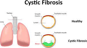 New Gene Therapy Could Treat Cystic Fibrosis With One Dose