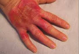 Image result for Erysipeloid