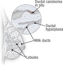 Adenocystic carcinoma (adenoid cystic carcinoma) carcinoma marked by cylinders or bands of hyaline or mucinous stroma separated or surrounded by nests or cords of small epithelial cells, occurring in the mammary and salivary glands, and mucous glands of the respiratory tract. Understanding Ductal Carcinoma In Situ Harvard Health