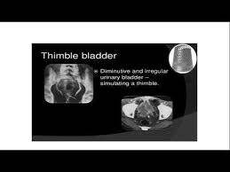 Image result for Genitourinary Tuberculosis