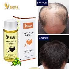 Patchouli essential oil reduces dandruff which can be one of the major causes of baldness. 20ml Hair Oil Fast Hair Growth Essence Human Baldness Natural Herbal Powerful Hair Growth Treatment Fluid Anti Hair Loss Hair Scalp Treatments Aliexpress