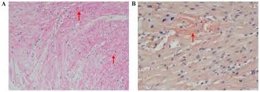 The different types of although less common than renal or cardiac involvement, neuropathy may be a significant problem in the localized form of amyloidosis, air passages and ducts may be obstructed by amyloid deposits. Cerebral Embolism Secondary To Cardiac Amyloidosis A Case Report And Literature Review