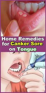 Home Remedies For Canker Sores On Tongue Diy Crafts Tutorials In 2020 Canker Sore Remedy Canker Sore On Tongue Tongue Sores