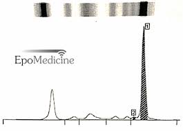 Serum protein electrophoresis will reveal localized spikes in the α or γ regions. M Spike Epomedicine
