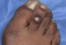 Check spelling or type a new query. Pictures Of Skin Diseases And Problems Corns