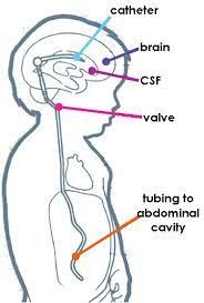 Picture Of Vp Shunt Google Search Vp Shunt Catheter Pictures