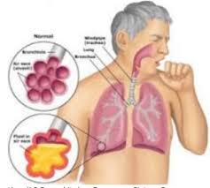 Situasi yang mengejutkan banyak orang ini, sebenarnya telah. Sebutkan Tiga Penyakit Dan Gangguan Sistem Pernapasan Manusia