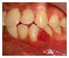 Image result for granuloma gum disease